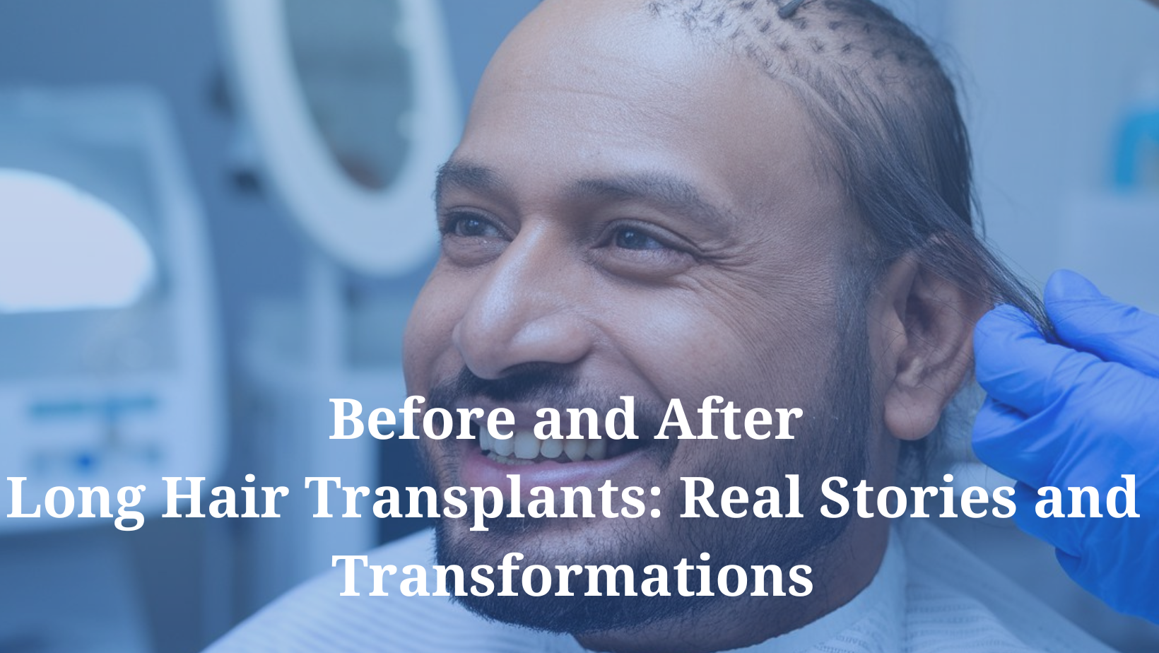 Before and After Long Hair Transplants: Real Stories and Transformations