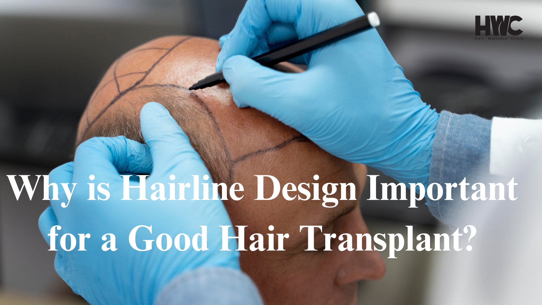 Long hair transplant - Hair transplant without cutting or shaving head in Kerala - HWC